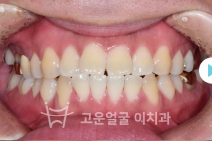 치료후기 이미지
